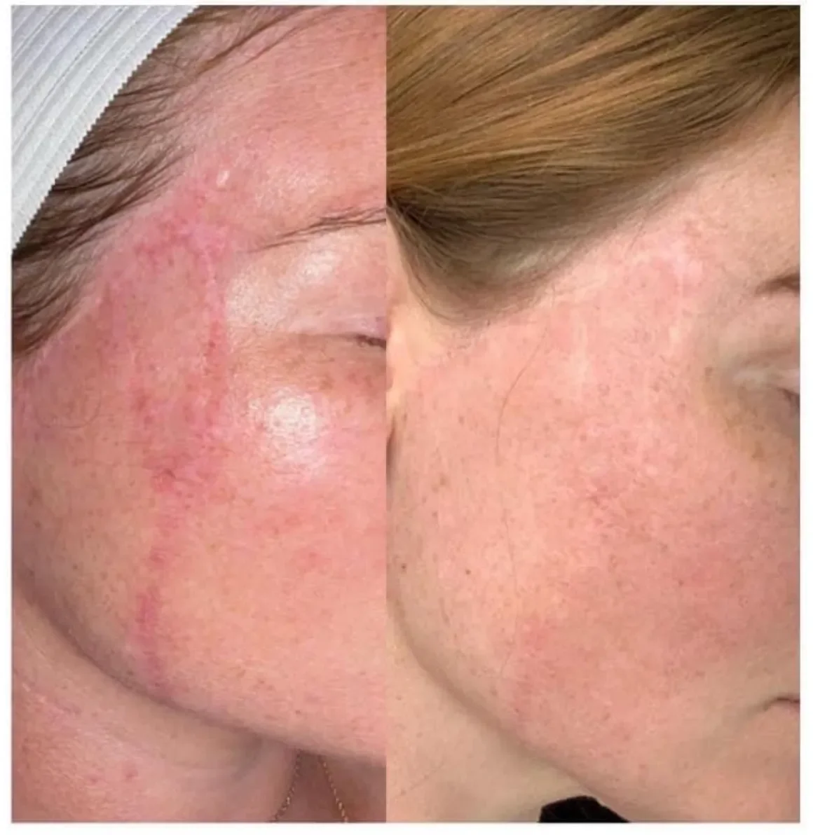Surgical Scar & After 2 sessions