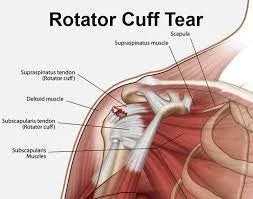 Rotator Cuff Injuries: What You Need to Know