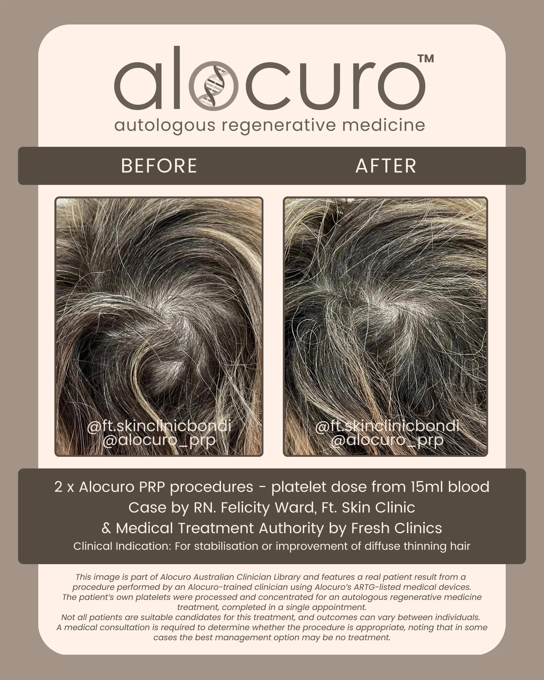 Alocuro Hair Case PRP - Before & After - 26.jpg