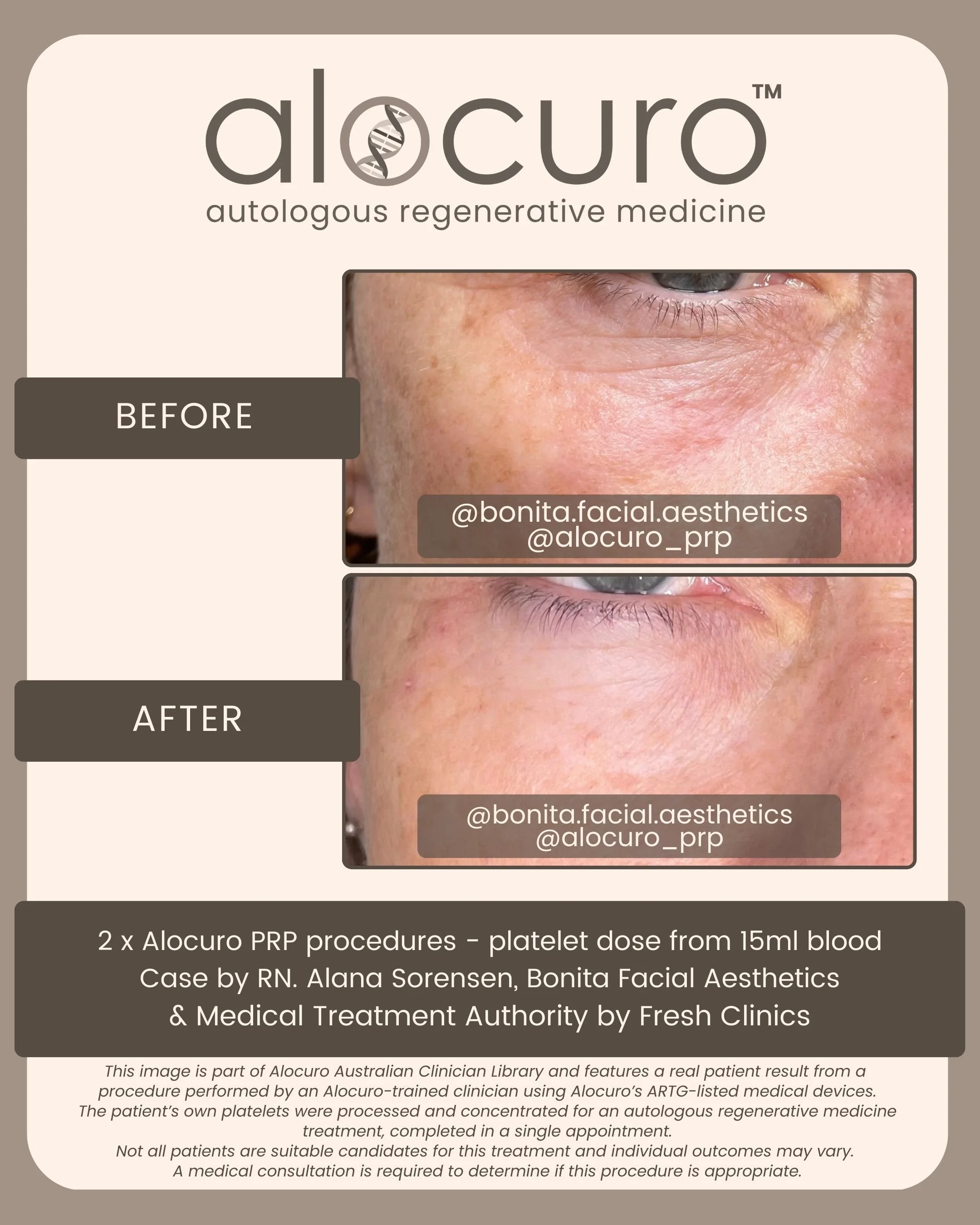 Alocuro Skin Case PRP - Before & After - 27.jpg