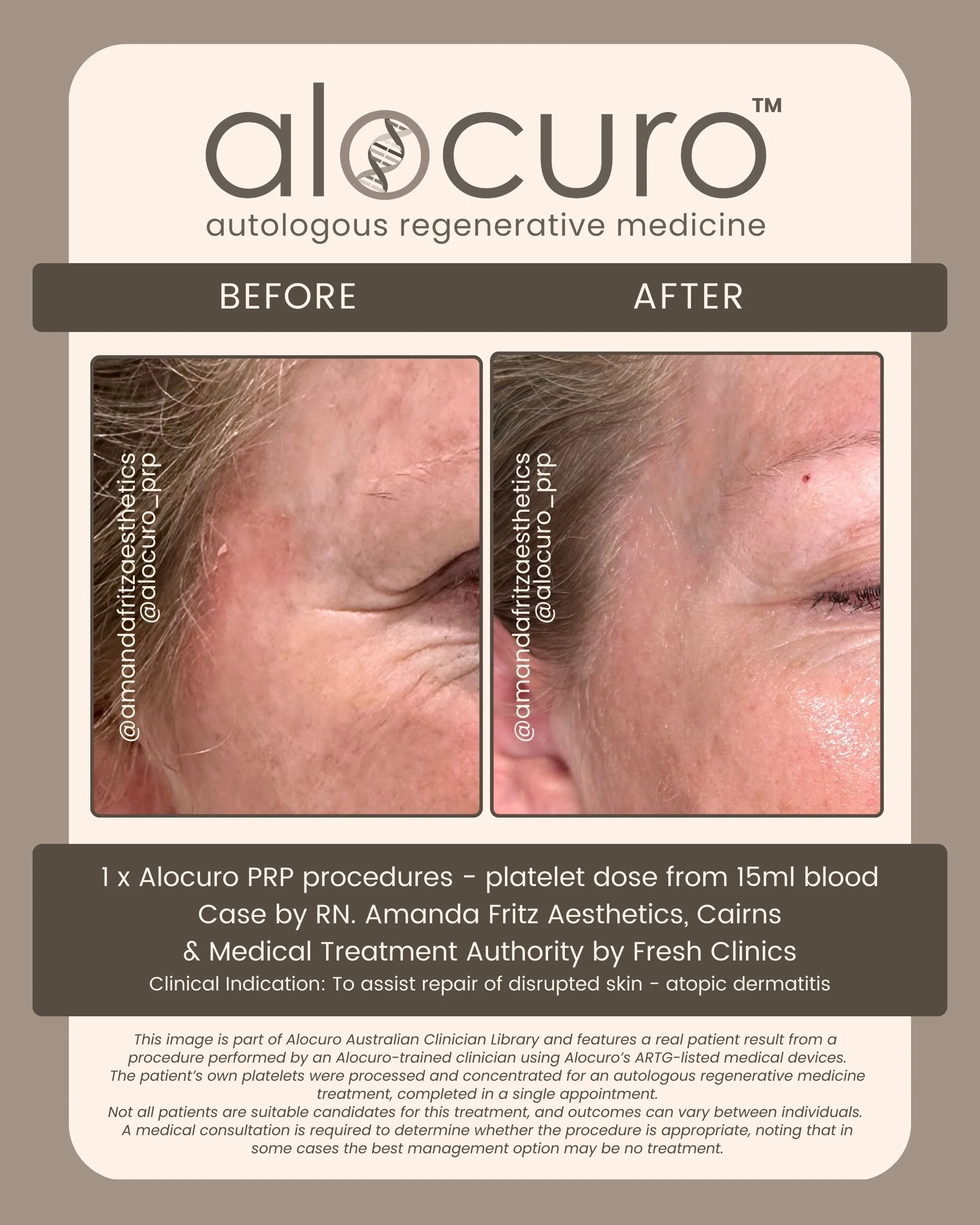 Alocuro Skin Case PRP - Before & After - 29.jpg