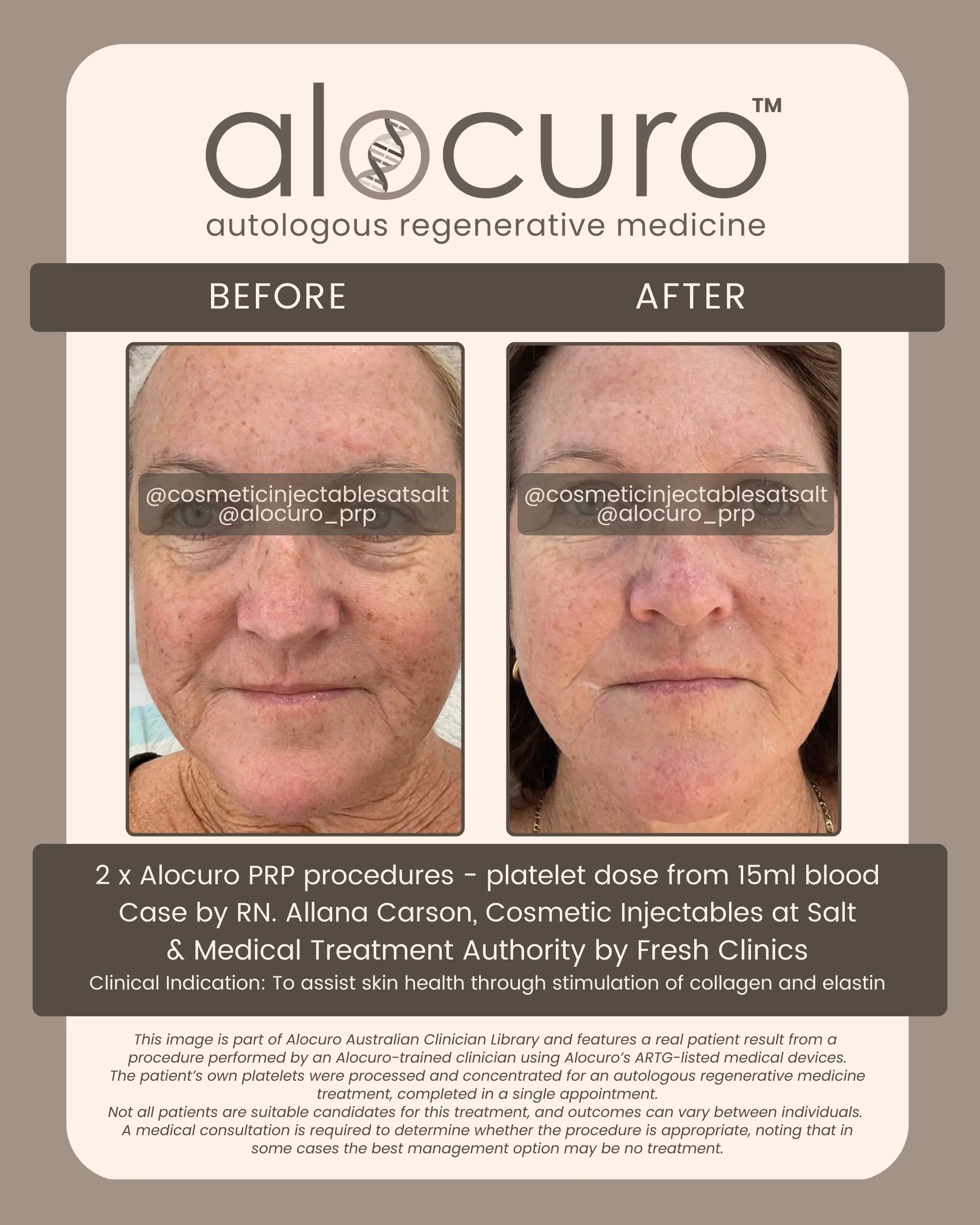 Alocuro Skin Case PRP - Before & After - 31.jpg
