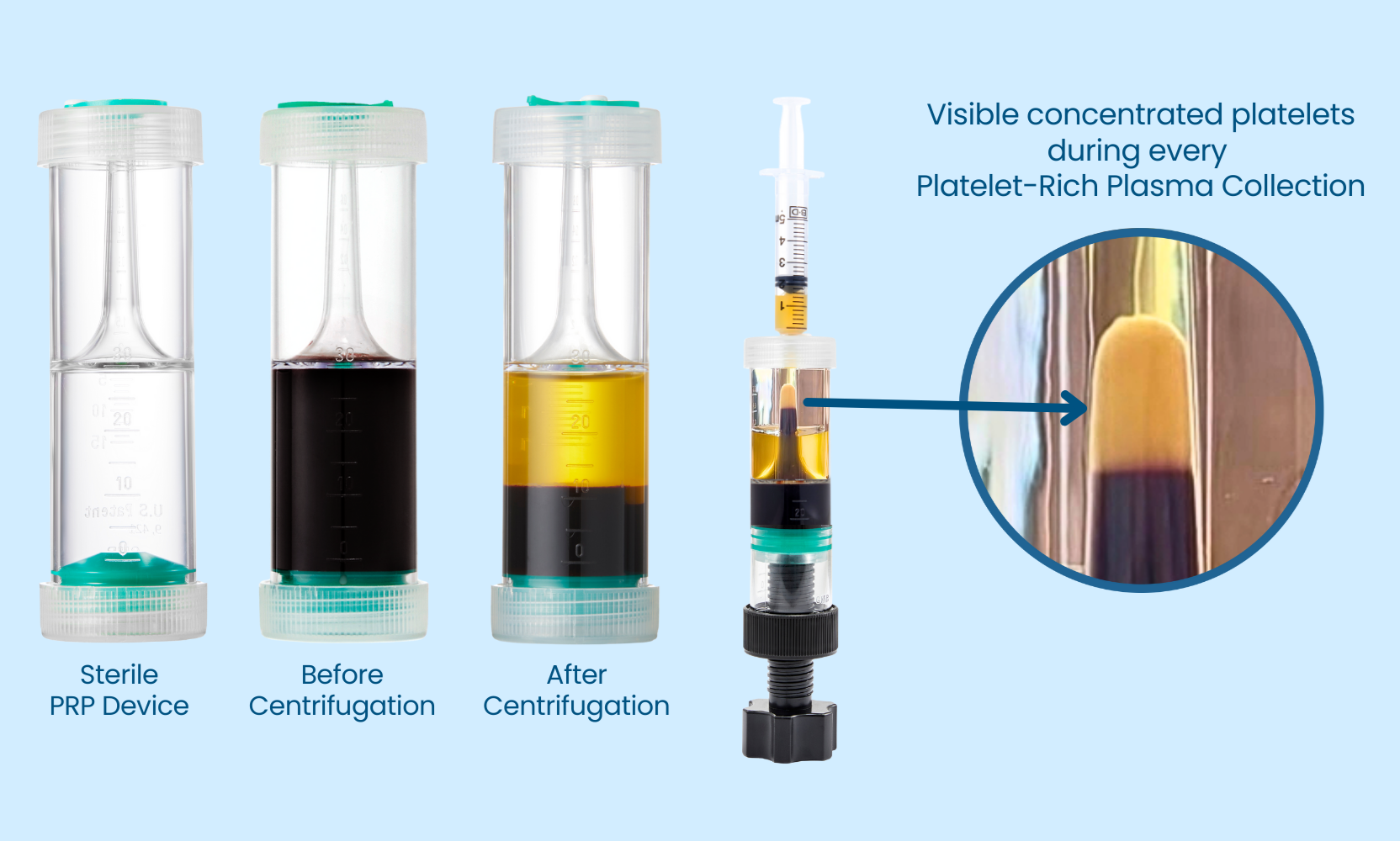 Illustration showing Alocuro's process of centrifugation and high yield platelet concentration for PRP procedures. Trusted by Australian clinicians for high platelet recovery, output control, and flexible PRP preparation.