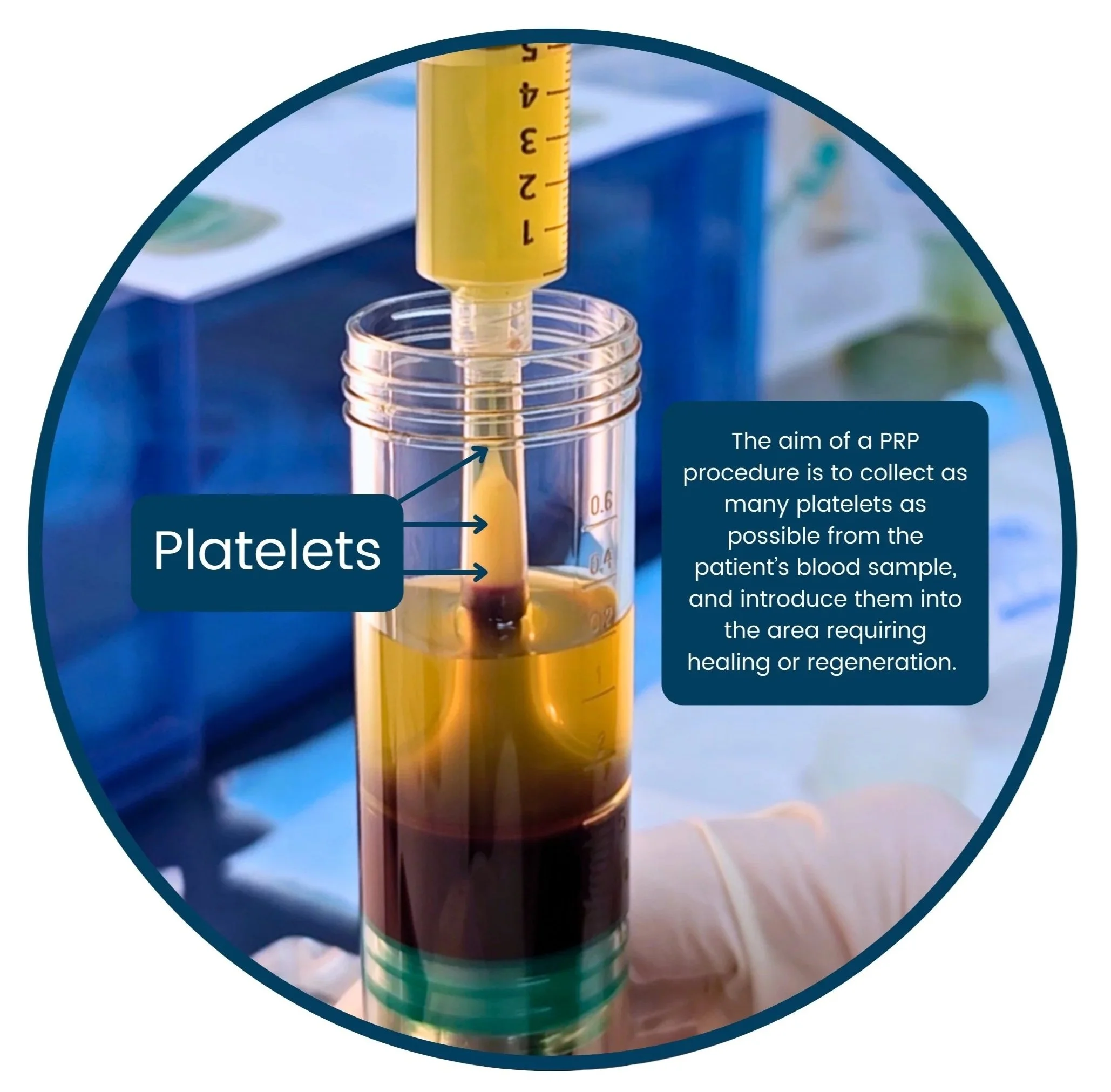 Leading PRP system Australia, performing high platelet dose PRP procedures