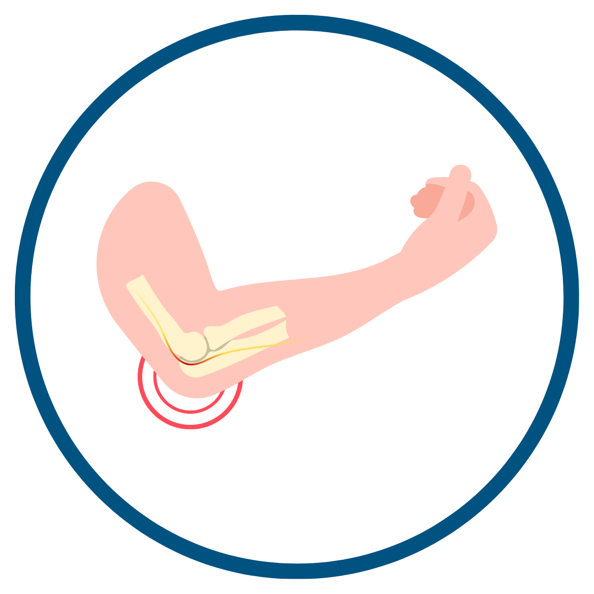 PRP preparation suitable for intra-articular and peri-tendinous applications where composition matters.