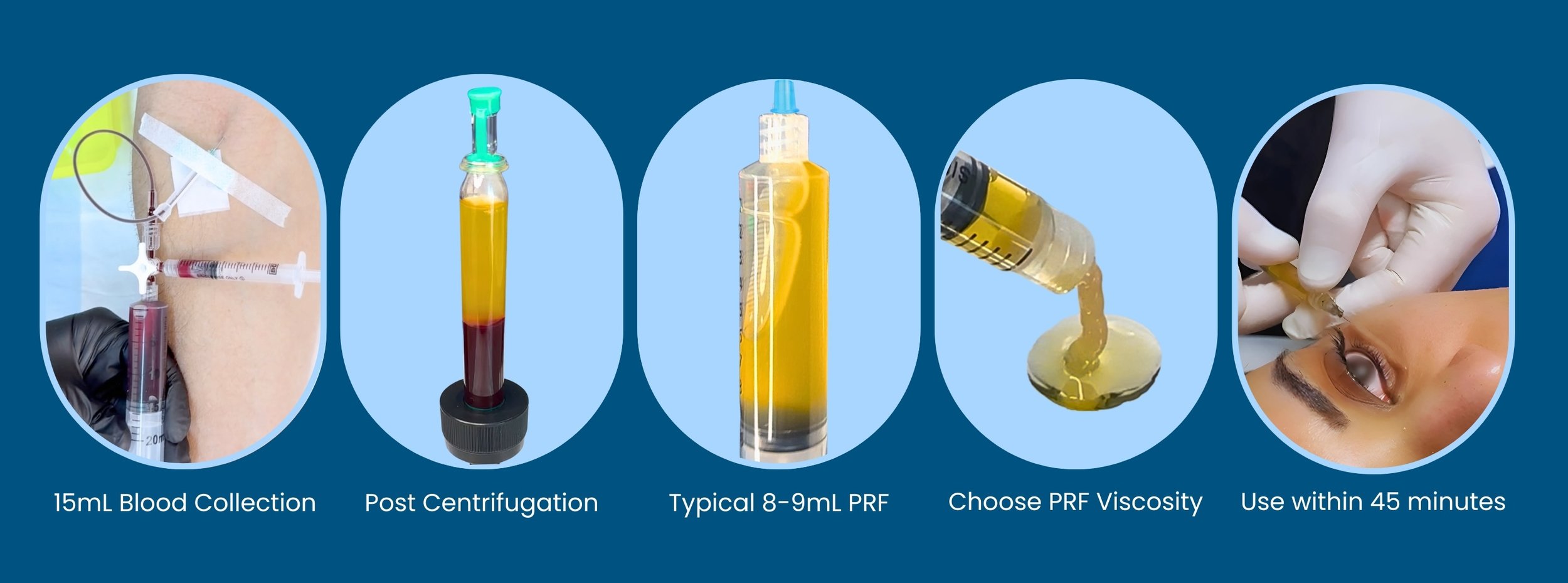 Platelet Rich Fibrin (PRF) | Enhance Treatments Today - Learn More ...