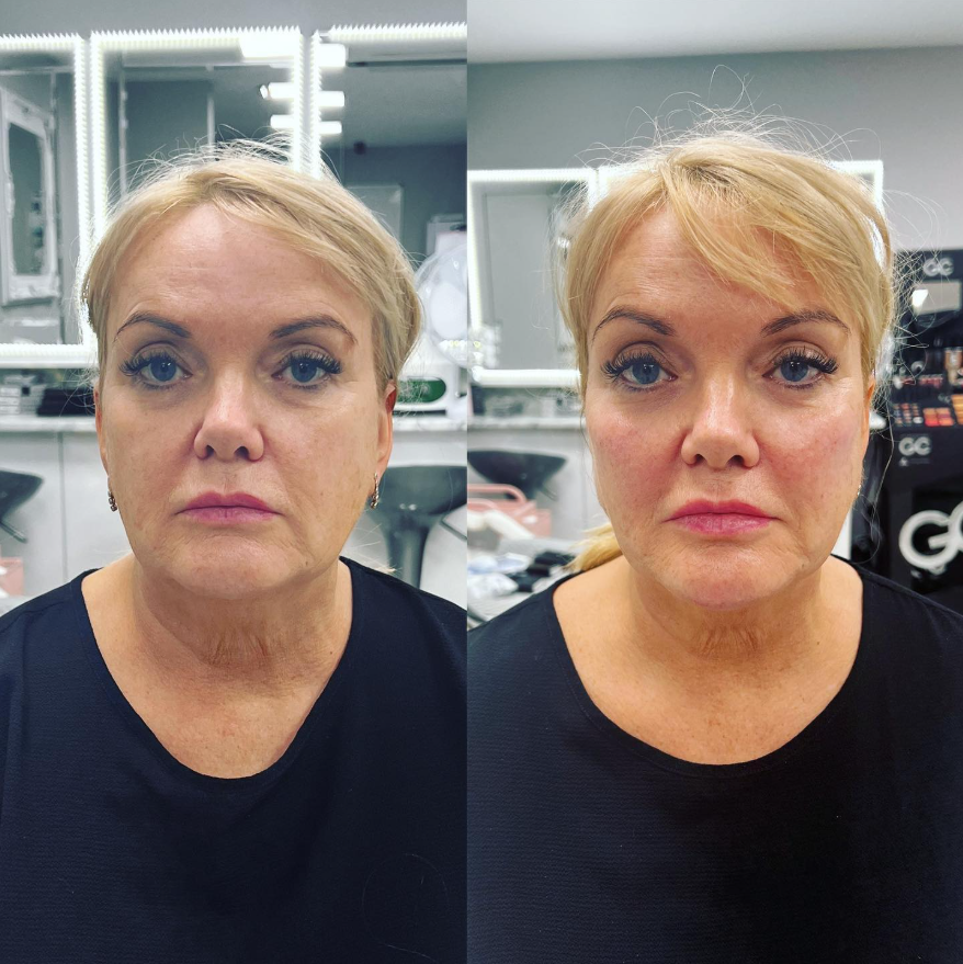 Cheek & Jaw Filler.png