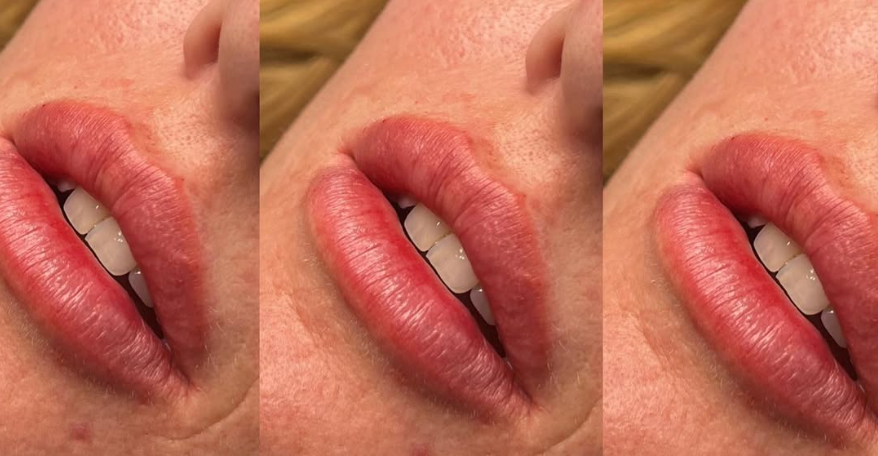 Lip Filler.png