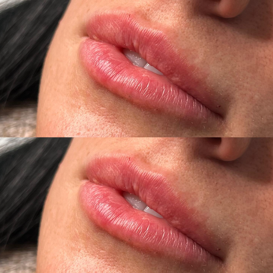 Lip Filler 2.png