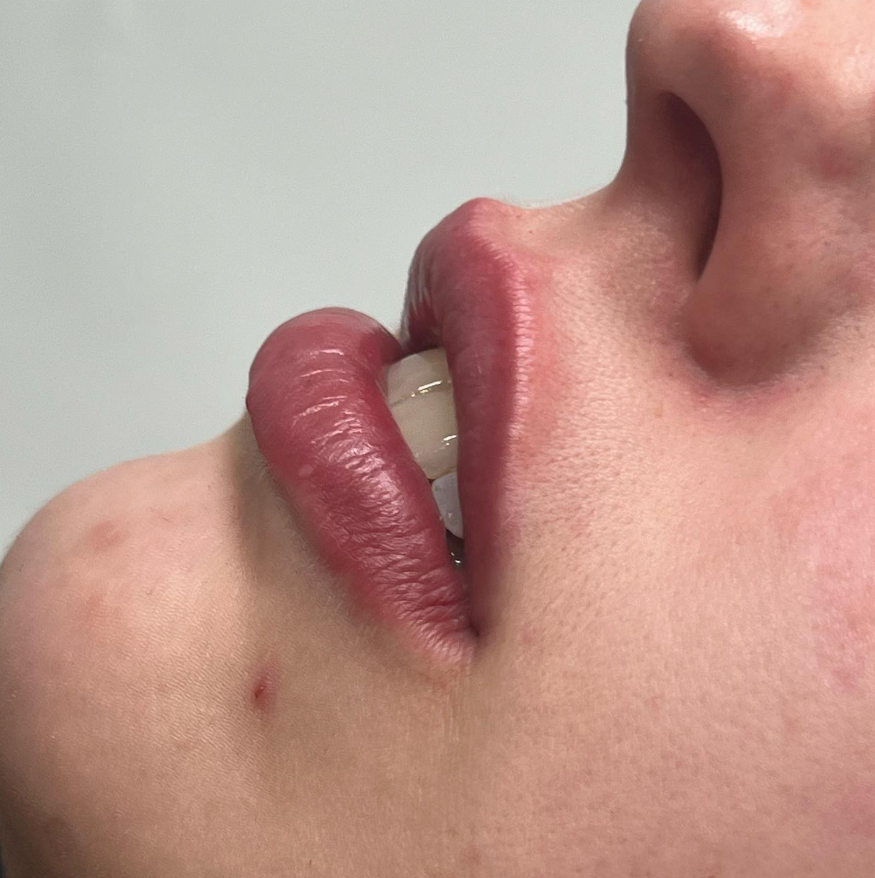 Lip Filler 3.png
