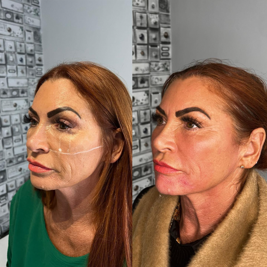 Facial Rejuvenation.png