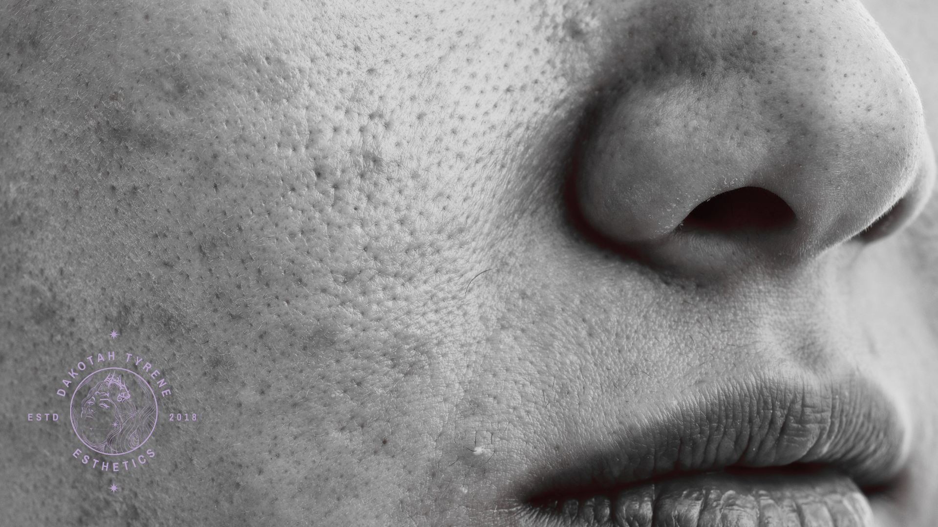 Hyperpigmentation Treatment: Why Dark Spots Keep Coming Back