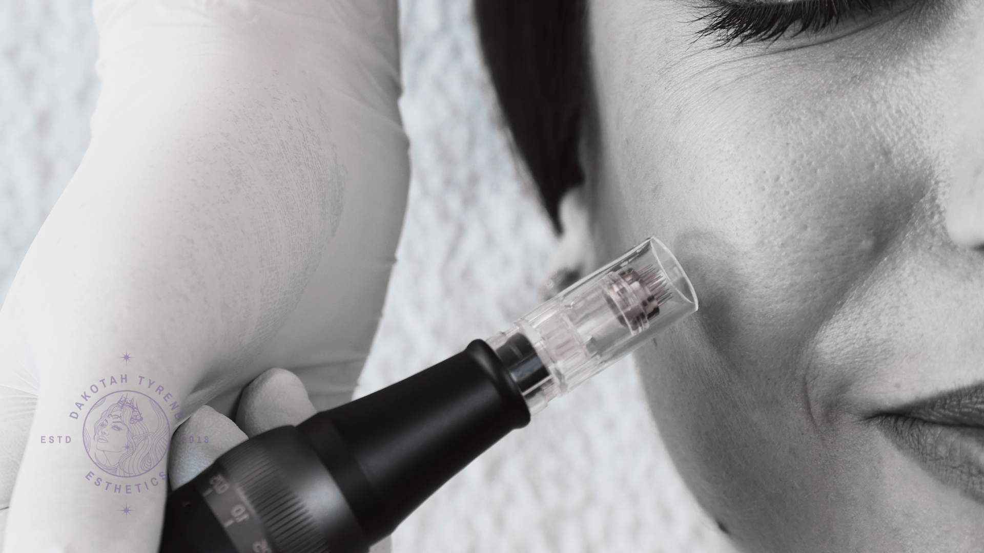 Microneedling for Acne Scars: How Collagen Induction Therapy Improves Skin Texture