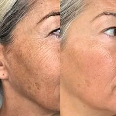 Customer before and after skincare result 3
