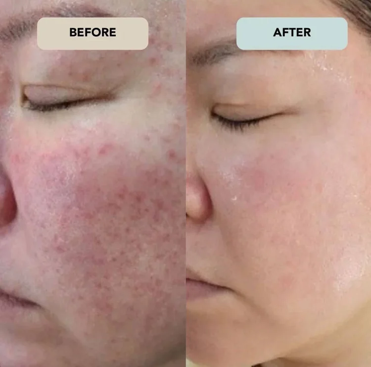 Customer before and after skincare result 1