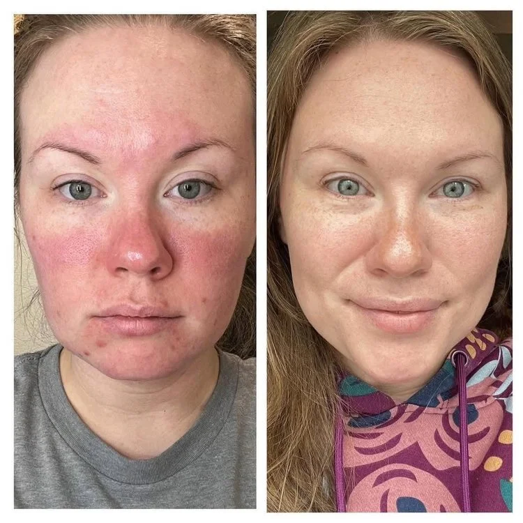 Customer before and after skincare result 2