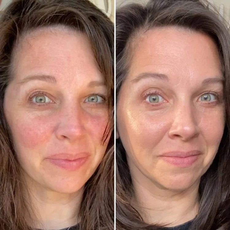 Customer before and after skincare result 7