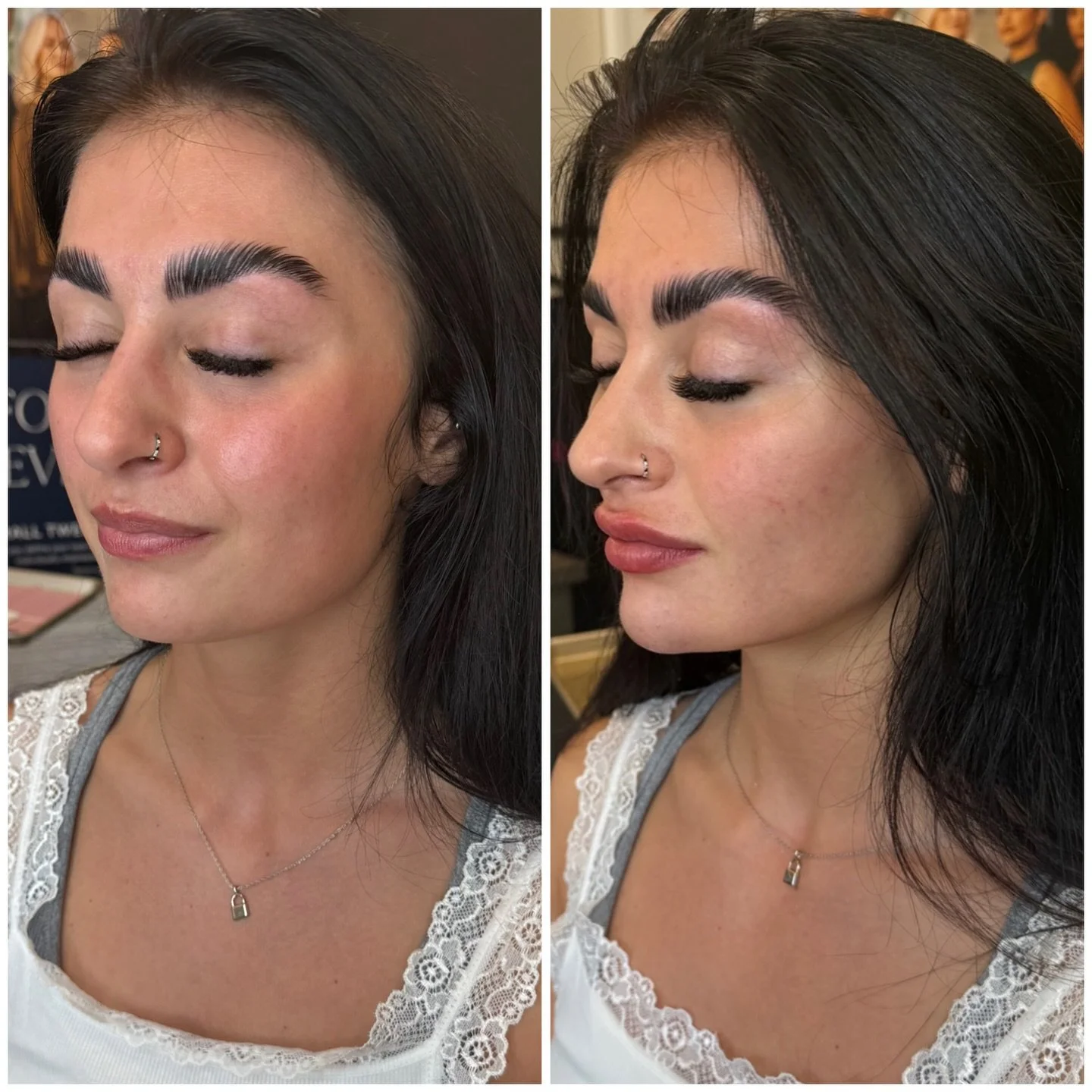 ✨Facial balancing isn&rsquo;t just for &ldquo;anti-aging&rdquo; &mdash; it&rsquo;s one of the top treatments younger clients are asking for.

💉 Cheeks &ndash; create sculpted contour without makeup
💉 Chin &ndash; sharpens the jawline + enhances pro