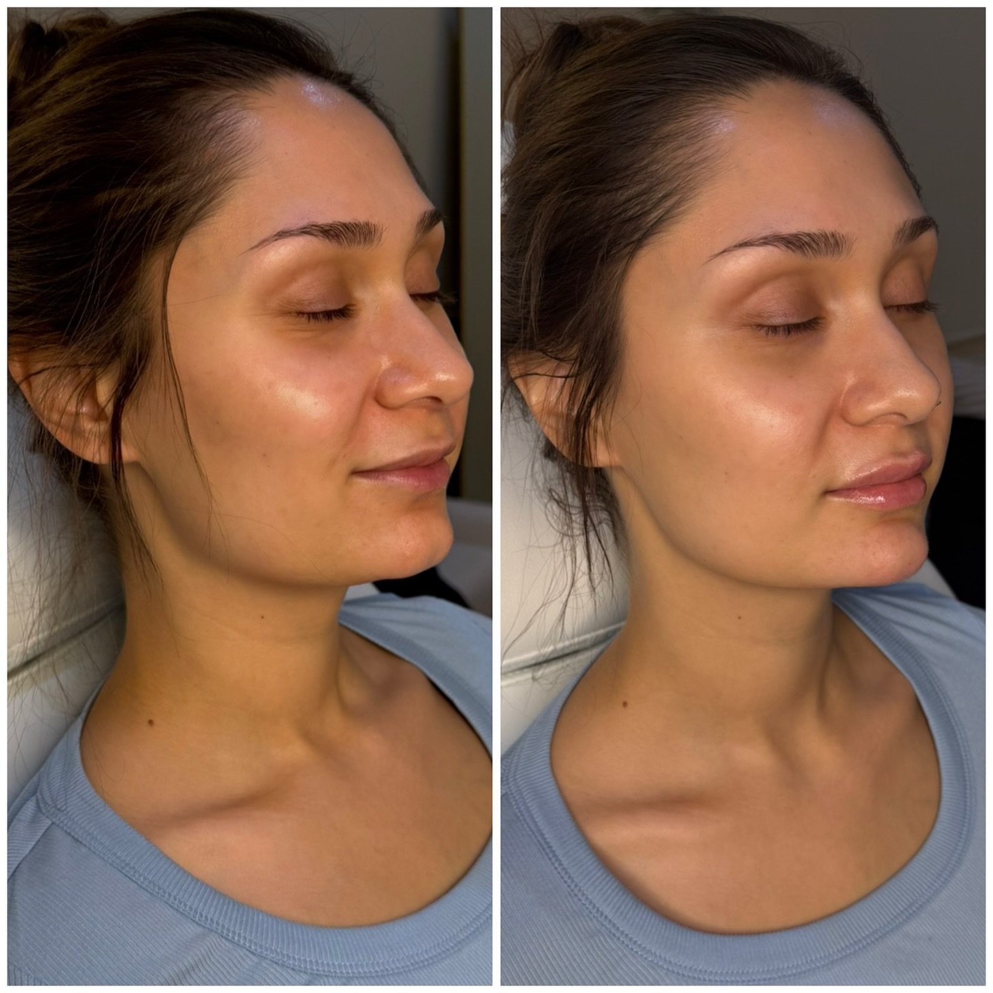 &ldquo;The lips shouldn&rsquo;t enter the room before the chin does.&rdquo; 💋

💉When enhancing the lips, it&rsquo;s just as important to balance the chin. In this treatment, &frac12; syringe to the lips and 1 full syringe to the chin created harmon