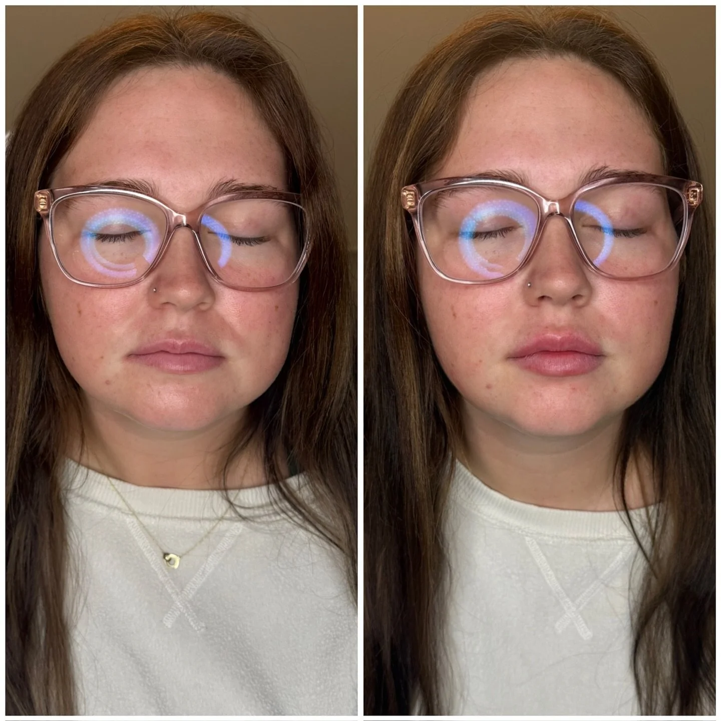 Sometimes it&rsquo;s not about changing your face &mdash; it&rsquo;s about enhancing what&rsquo;s already there.
A little filler can make a subtle, natural difference that brings out your best features and boosts your confidence in the most effortles