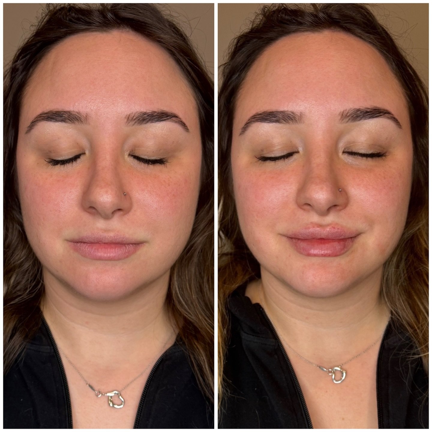 💋 One syringe was used to enhance and reshape her lips &mdash; focusing on defining the Cupid&rsquo;s bow and creating a soft, pouty lower lip.

💉Small adjustments like this maintain balance and harmony while adding natural volume and structure.

✨