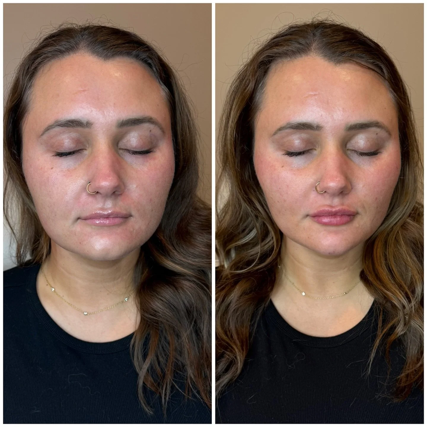 ✨Facial balancing is THAT girl.

💉A few strategic tweaks (using filler) in the cheeks, chin+lips and &hellip; SNATCHED. Contoured. Harmonized. Her face but elevated. 👏🏻 

Facial balancing isn&rsquo;t about changing your features! It&rsquo;s about 