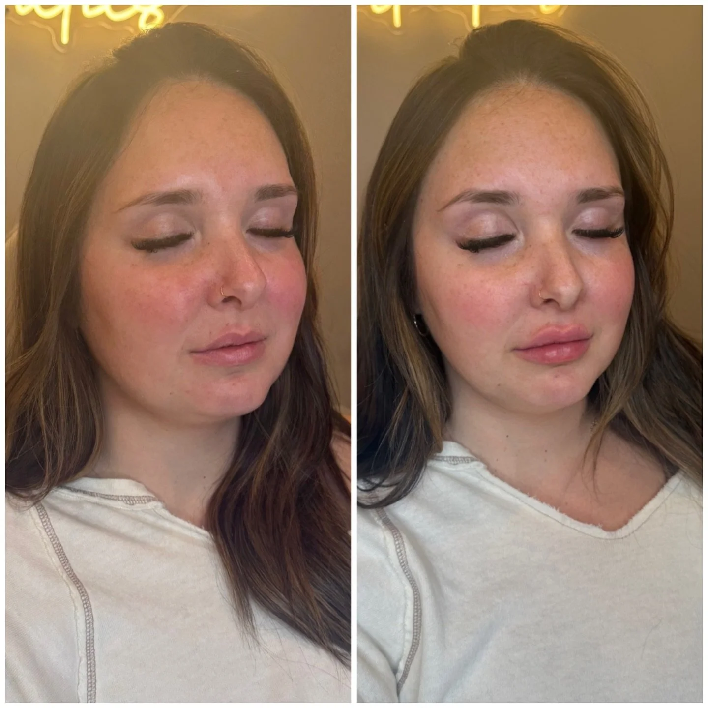 ✨First-time lip filler 🙌🏻

✨Bold, beautiful volume with a gorgeous shape. Results continue to refine as everything settles.

#gracefulbeautyaesthetics #mansfieldohio