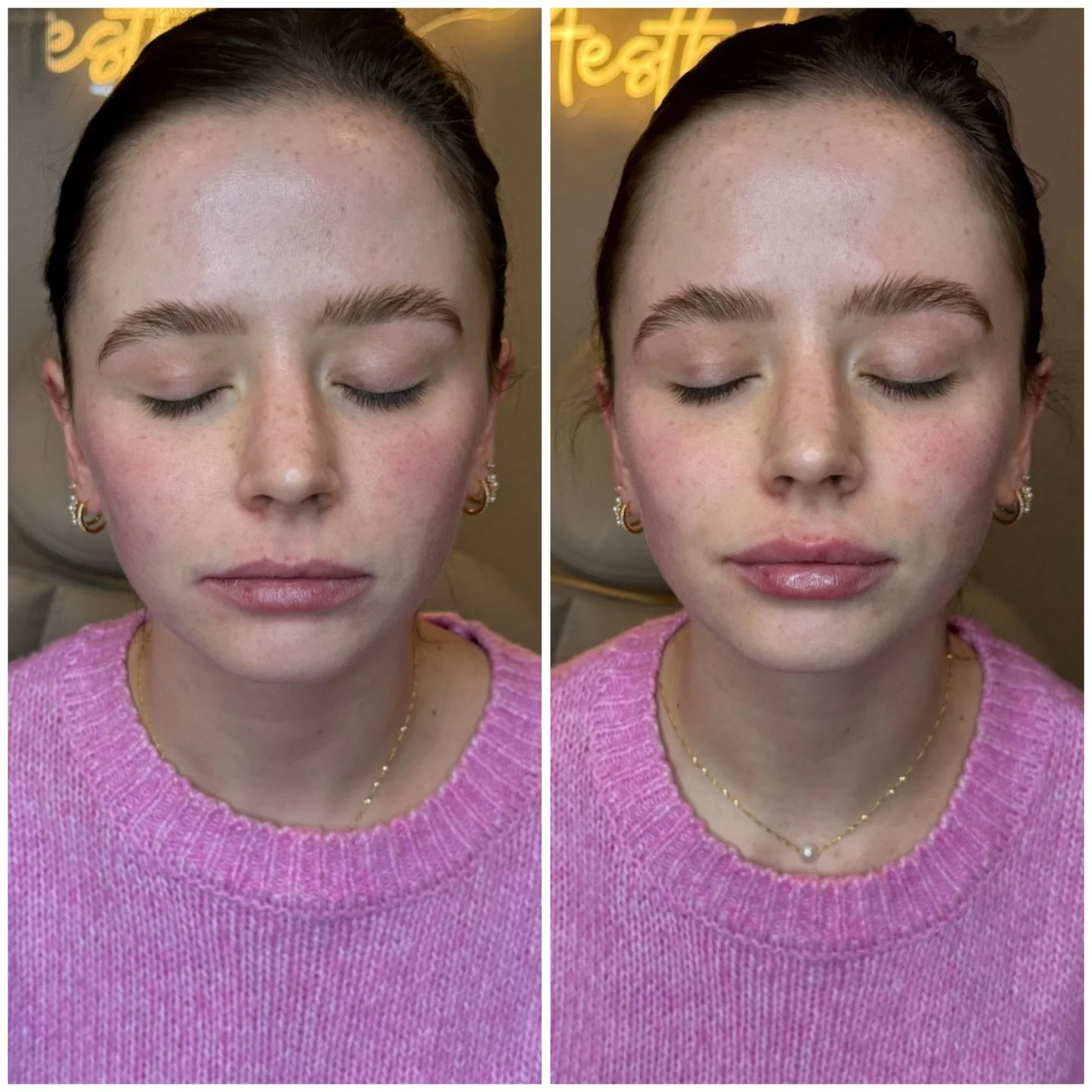 💉 Reminder: lip filler isn&rsquo;t about size &mdash; it&rsquo;s about structure 😌
Enhancing the vermillion border, improving hydration, and subtly balancing the top and bottom lip = chef&rsquo;s kiss results.

⏳ What to expect: swelling happens, t