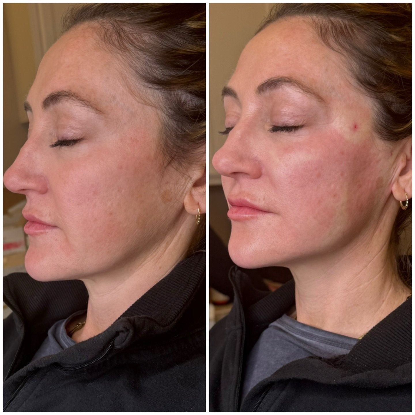 ✨ PDO MAX Threads ✨

✨Pictures 1&ndash;2 show an immediately before and immediately after, focusing on the nasolabial folds and marionette lines where the client felt heaviness prior to treatment. Some immediate fullness is expected and related to no