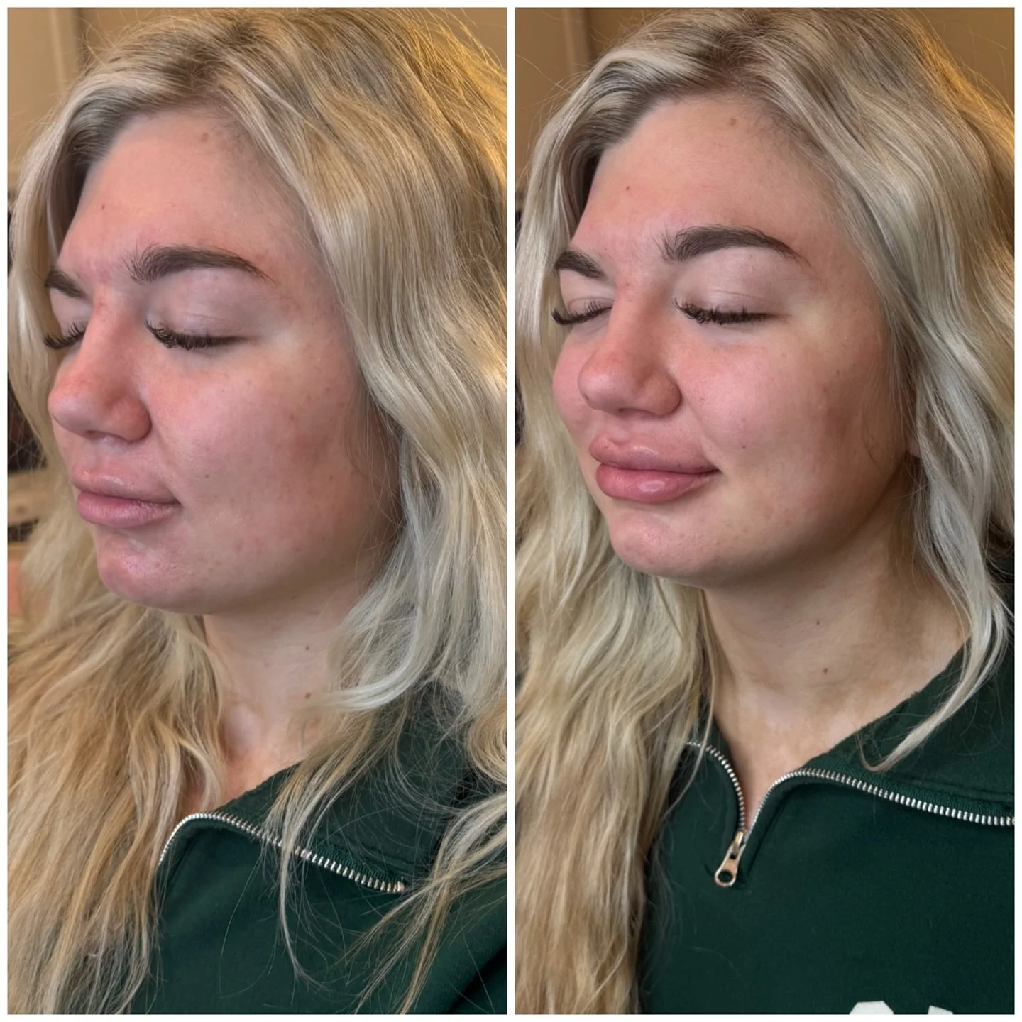 Full syringe lip filler ✨

Designed for balance, hydration, and natural enhancement.💉

Swelling will go down and results will continue to refine.
Arnica before and after treatment can help with swelling and bruising.💋

Book your consultation today 