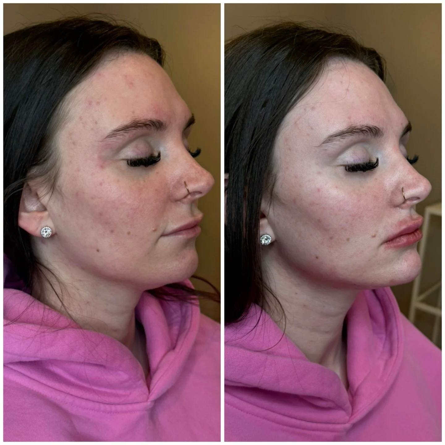 Subtle tweaks, big confidence ✨
We enhanced her natural structure with chin filler, jawline contouring, and a touch of lip filler to create balance, definition, and a softer profile.

Nothing overdone &mdash; just harmony, support, and that refreshed