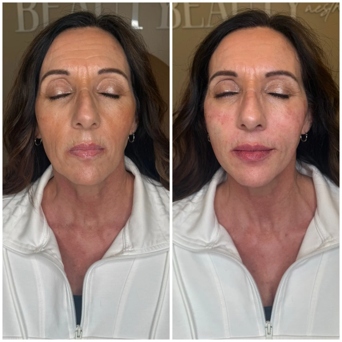 PDO MAX Threads transformation ✨

We lifted and supported her midface and jawline using lifting threads for subtle structure and contour, then added smooth threads around the smile lines and vertical lip lines to create collagen scaffolding for smoot