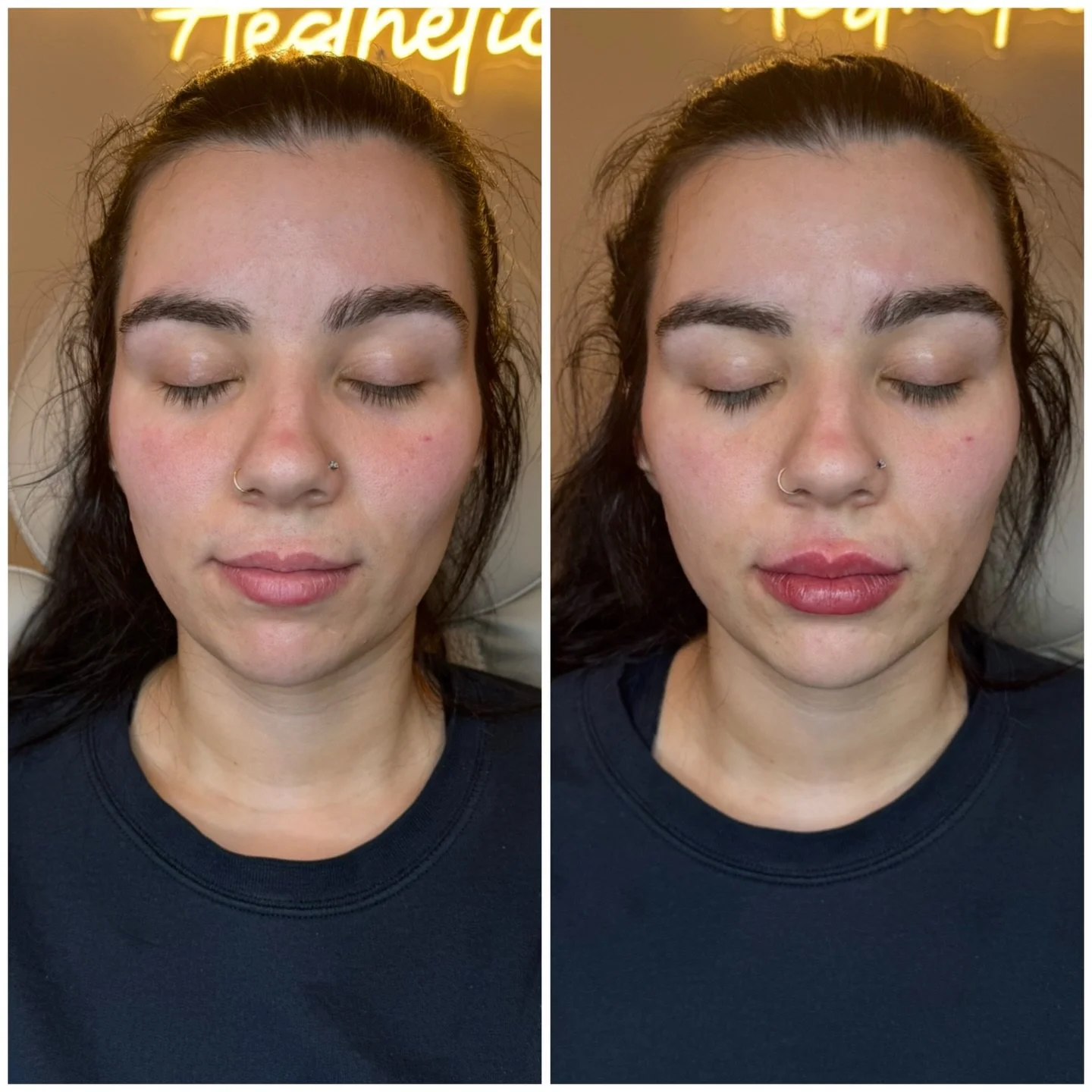 ✨ Full syringe. Soft volume. Balanced beauty.
This gorgeous lip enhancement adds hydration, shape, and fullness while keeping everything natural and proportionate.

A little swelling is normal right after &mdash; final results only get better over th
