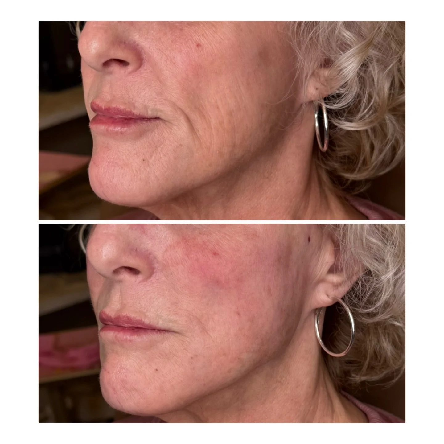 PDO Max Threads before &rarr; after ✨

A subtle lift, softer definition, and collagen stimulation that keeps working long after treatment. We focused on lifting the midface and jawline, then added smooth threads in the neck for extra collagen support