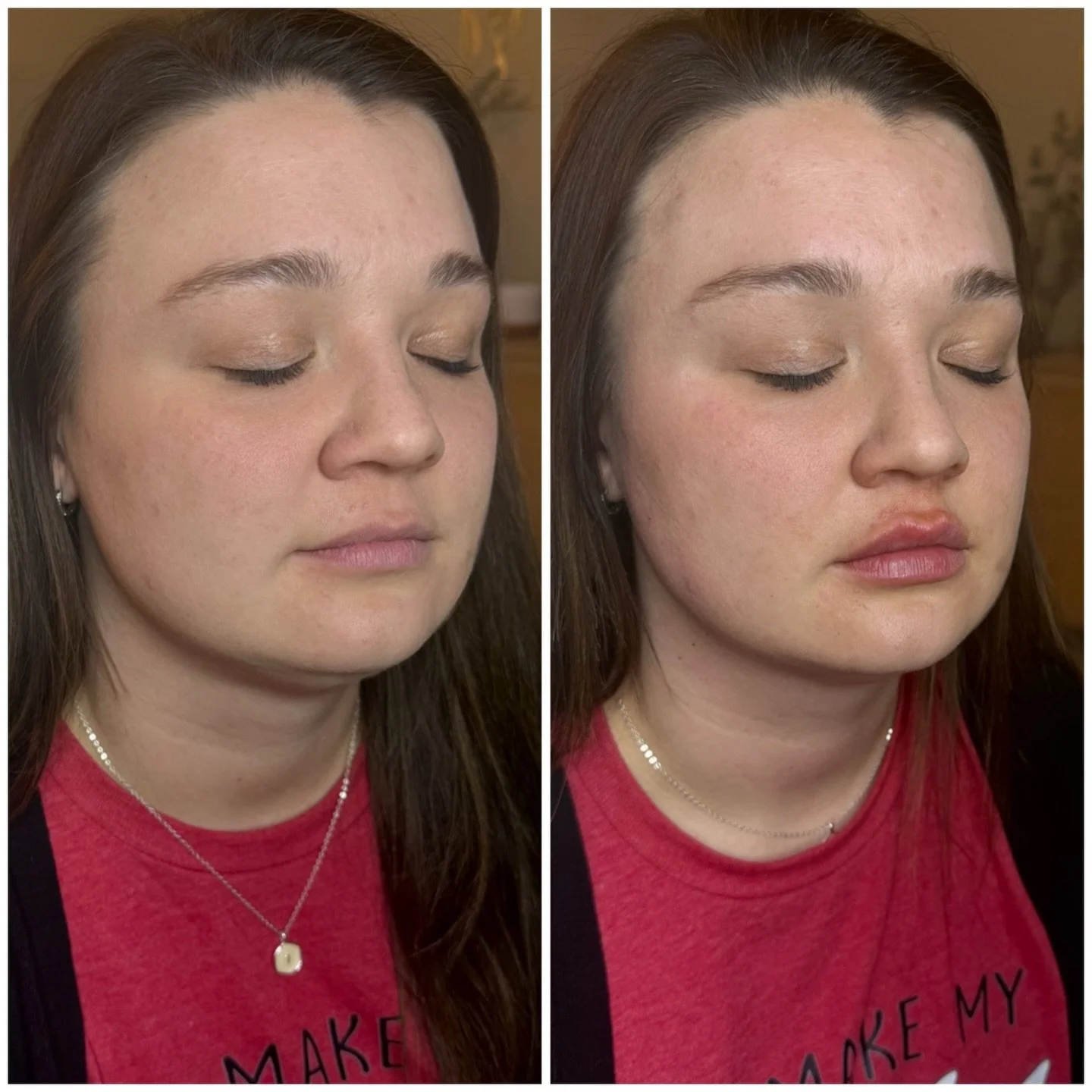 💋 Pretty, polished, and a noticeable pout. A full syringe enhanced her Cupid&rsquo;s bow and added beautiful volume for lips that still fit her face &mdash; just fuller, smoother, and more defined.

✨ There is some normal post-treatment swelling rig