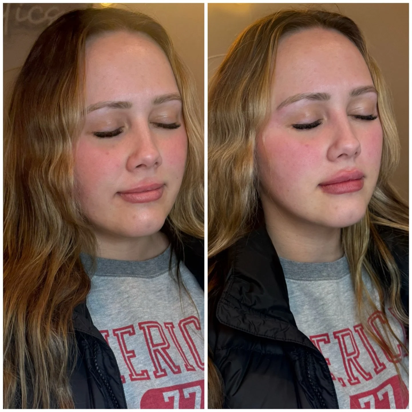 👄 Lip filler is about shape, structure, and balance,&nbsp;not just size. In this transformation, we enhanced natural definition, improved symmetry, and restored soft volume for a result that looks effortless and refined.

Strategic placement makes a