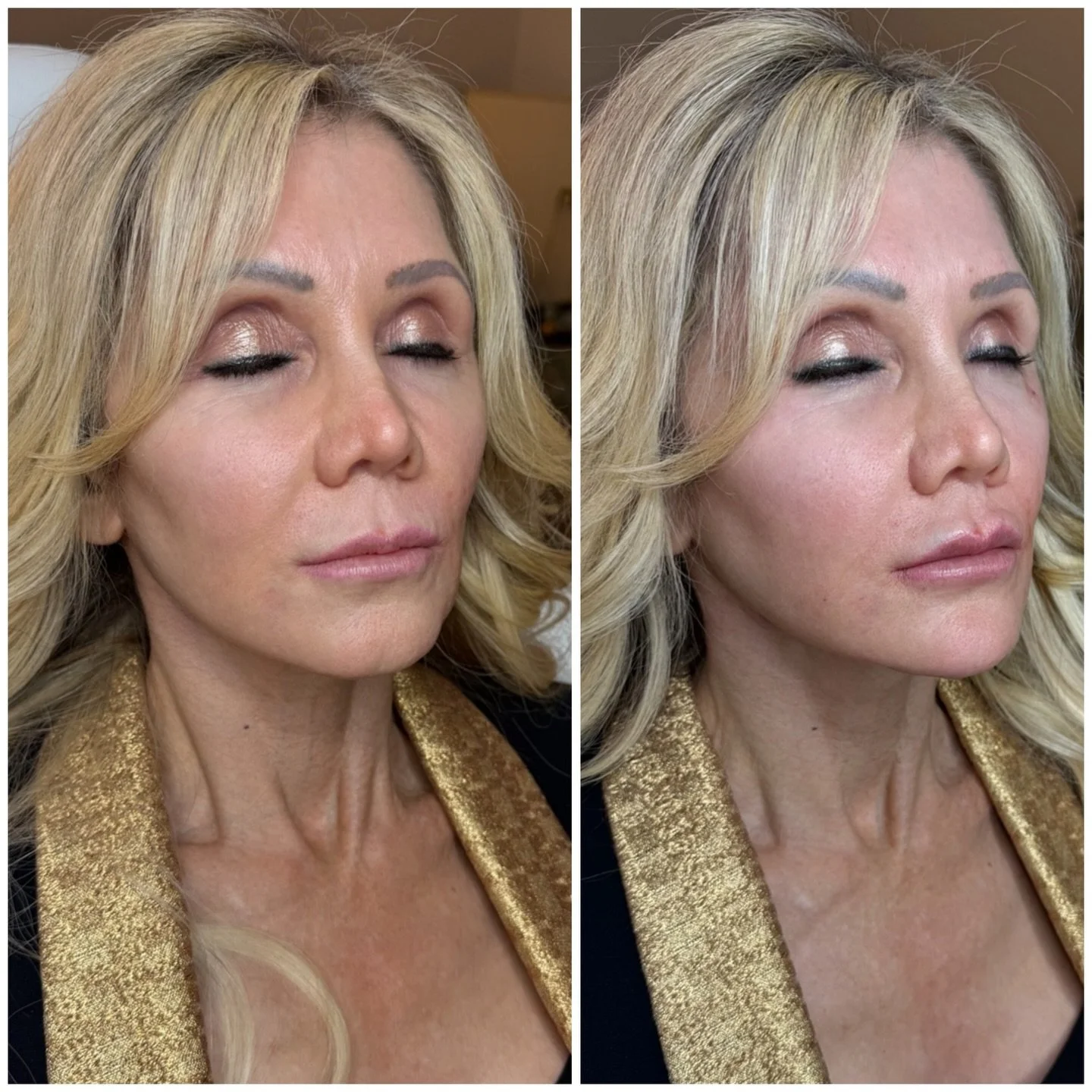 💉 Subtle balance. Major difference. 👏🏼

This beautiful client had:
&bull; Lip filler for hydration + structure
&bull; Chin filler for projection + balance
&bull; Perioral filler (lines around the mouth) for softening + support

Let&rsquo;s talk ab