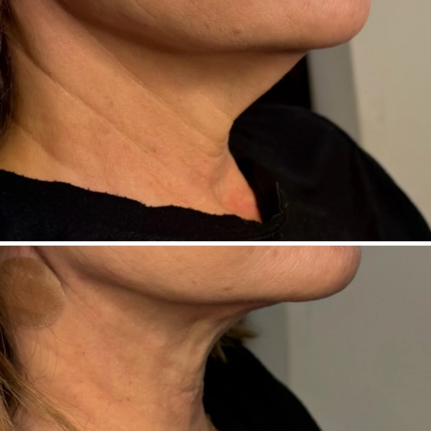 The NECK does not lie&hellip; and this transformation speaks for itself. 👏🏼

PDO Max Threads are designed to lift, tighten, and stimulate your own collagen production in areas that tend to show aging first, especially the neck.

As we age, collagen