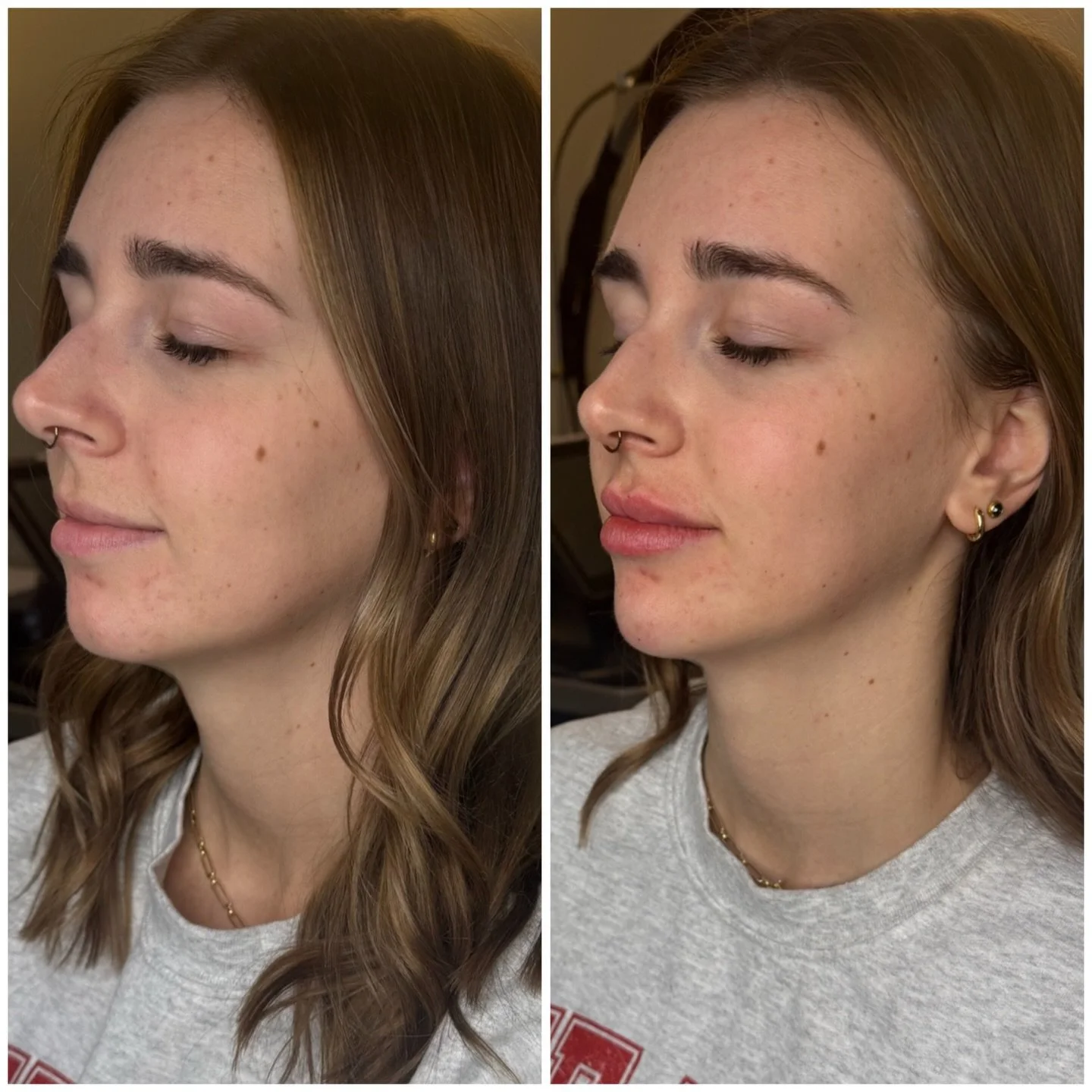 ✨A little structure + a little hydration. 

Chin filler helps balance the profile, support the lower face, and create that soft, sculpted look. Lip filler? We focus on shape, symmetry, and hydration. 💧

💉 When the chin and lips are treated together