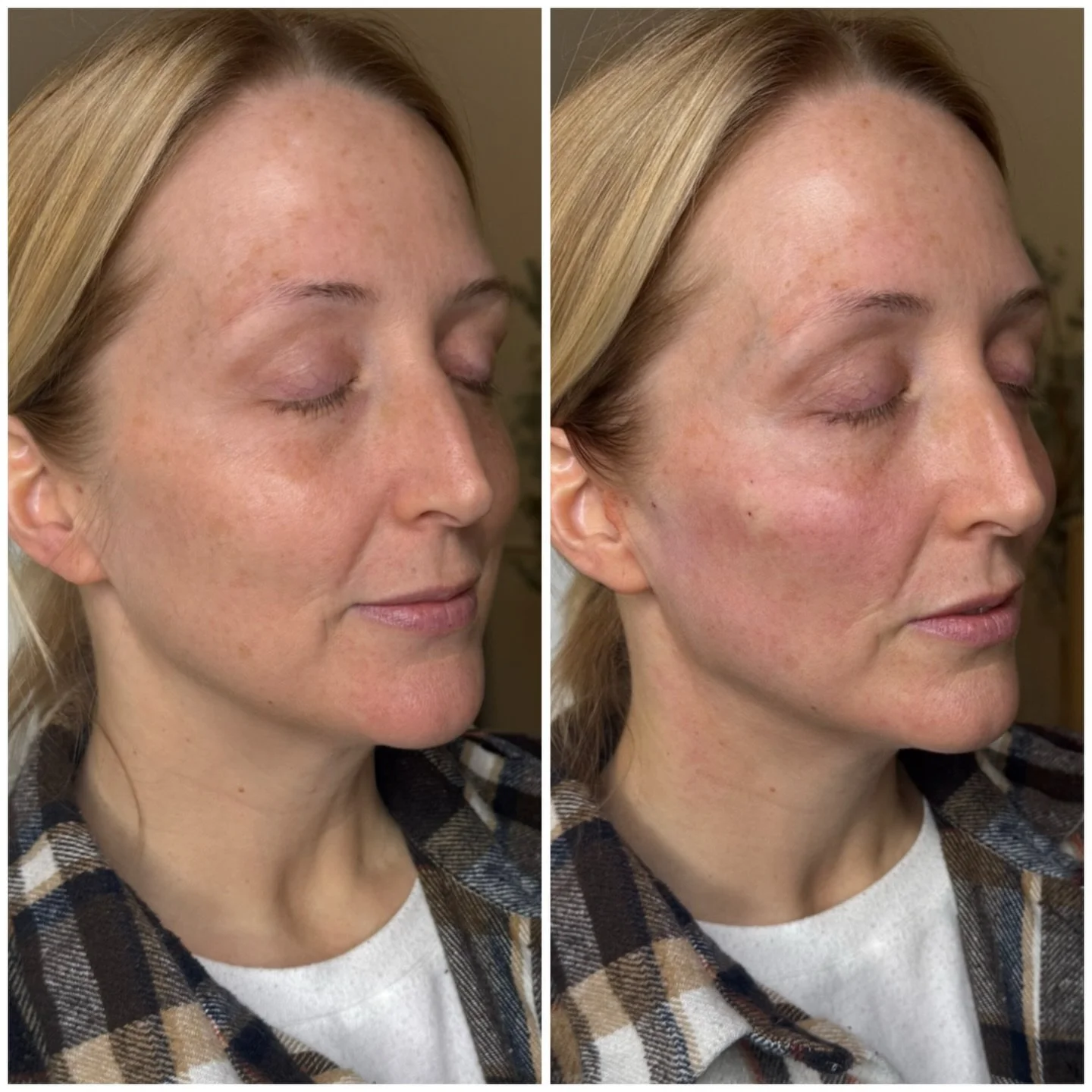 🪡💉This result was achieved using PDO Max threads in the jawline to lift and tighten while stimulating collagen, paired with cheek filler to restore support and enhance natural contour. 

💉Treating the midface helps define the jawline and creates a