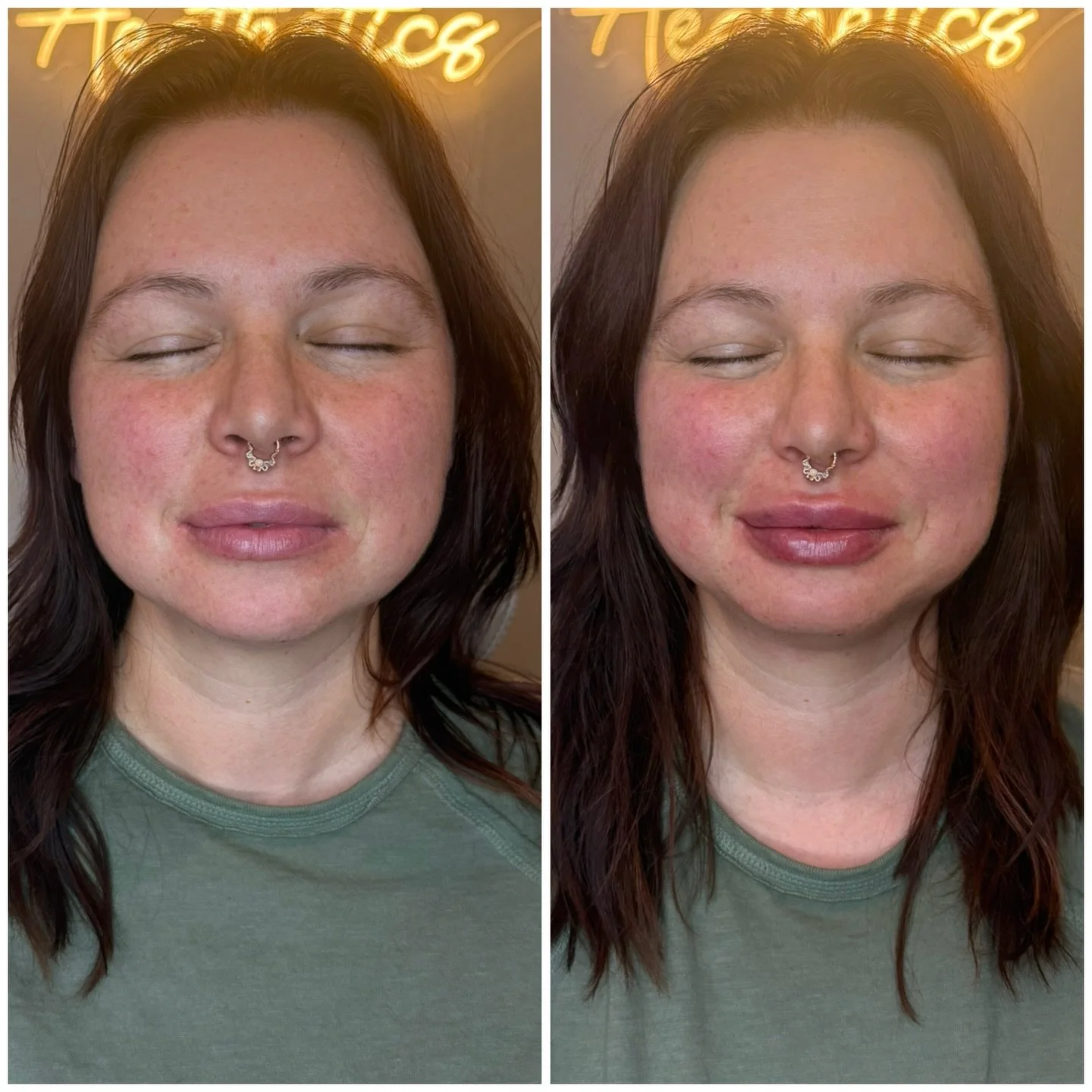✨The kind of result people notice&hellip; without knowing why.

💉One syringe added soft structure, refined the borders, and brought balance back to the lips.

💉Graceful Beauty Aesthetics, Ohio Med Spa
📍104 N Main St. Mansfield, Ohio 44902
📍233 S 