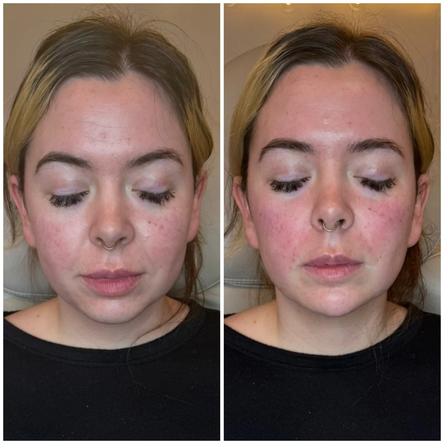 Cheeks + chin = the quiet power duo. ✨

💉Strategic cheek filler restores support through the midface, which can soften smile lines, lift the lower face, and bring back that smooth, youthful contour. Chin filler helps balance the profile, strengthen 