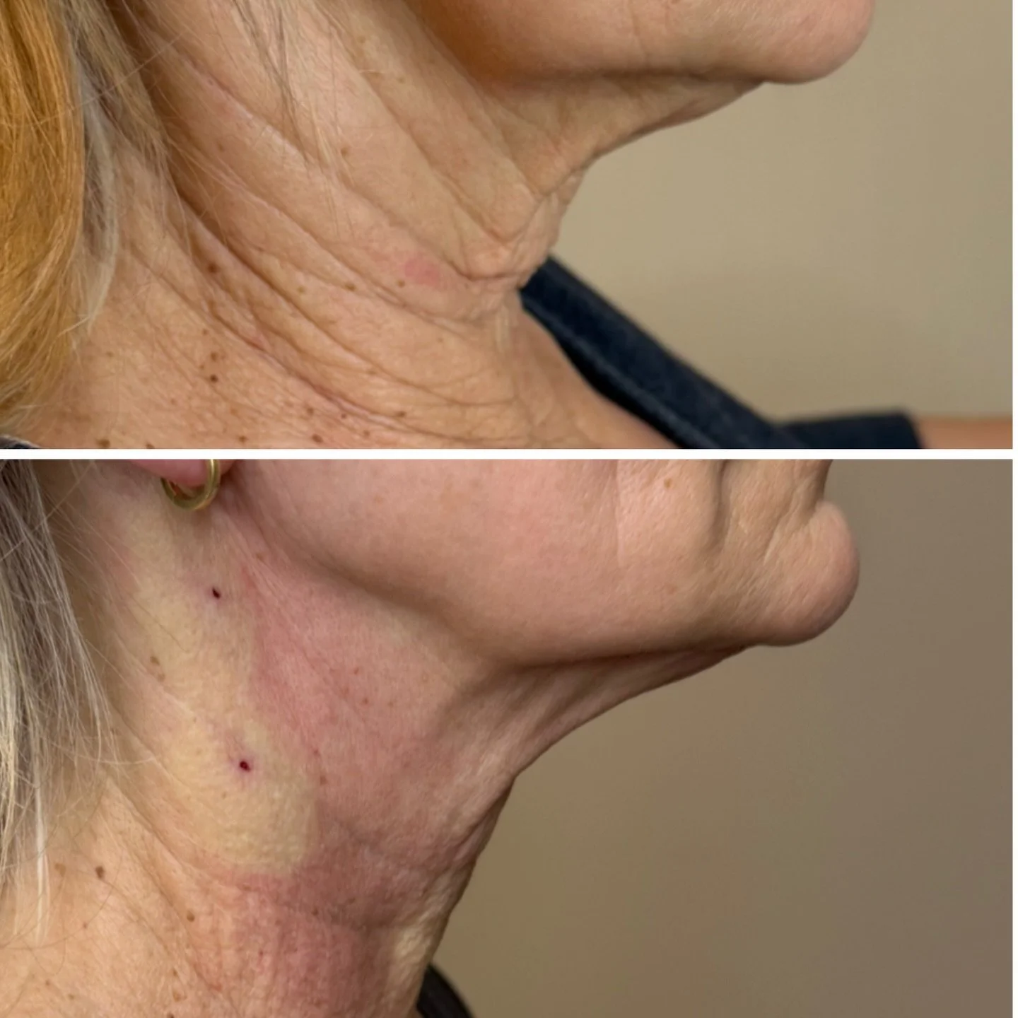 ✨The neck is one of the first areas to show aging, but it&rsquo;s also one of the most satisfying areas to treat when done right.

🧵PDO Max threads work by placing dissolvable threads under the skin to create an instant lifting effect while also sti