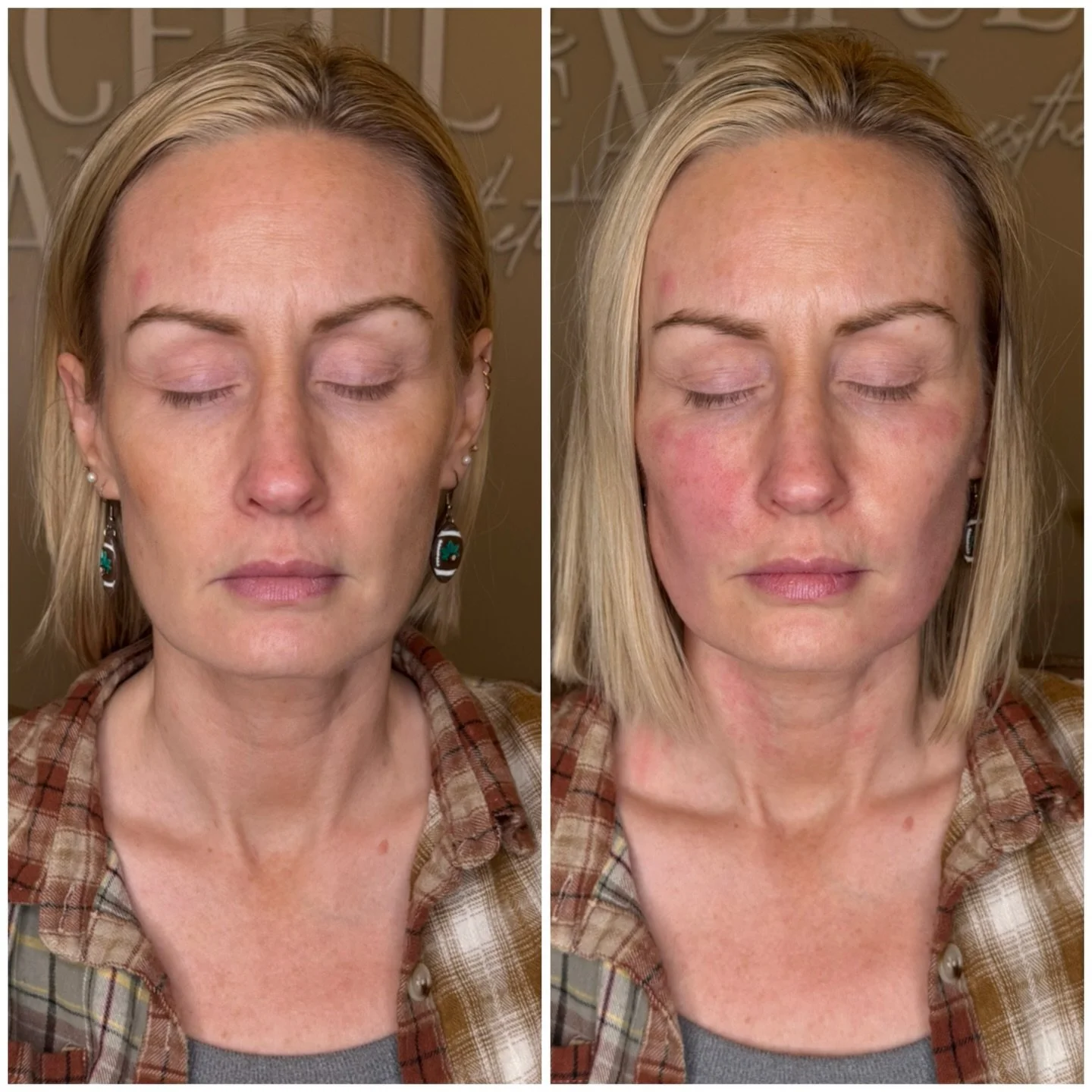 🧵 PDO threads doing exactly what they&rsquo;re supposed to do &mdash; snatch, sculpt, and redefine.

Graceful Beauty Aesthetics | Ohio Med Spa
📍104 N Main St. Mansfield, Ohio 44902
📍233 S Main St. Findlay, Ohio 45840
📞419-520-7127

#pdothreads #t