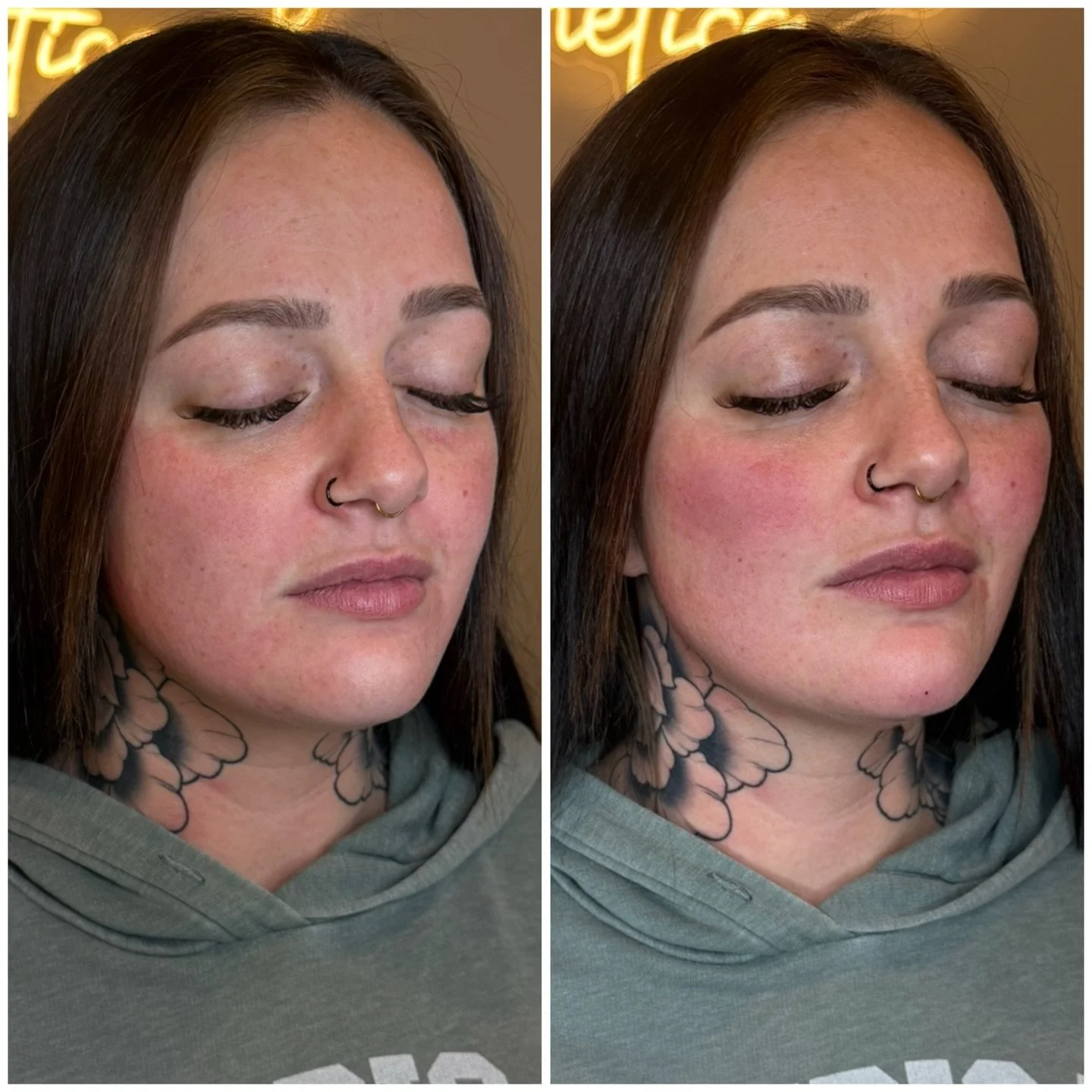 ✨ Facial balancing in action ✨

Sometimes the goal isn&rsquo;t to change your face &mdash; it&rsquo;s to bring everything into harmony. Facial balancing uses strategically placed filler to enhance natural structure, soften shadows, and create better 