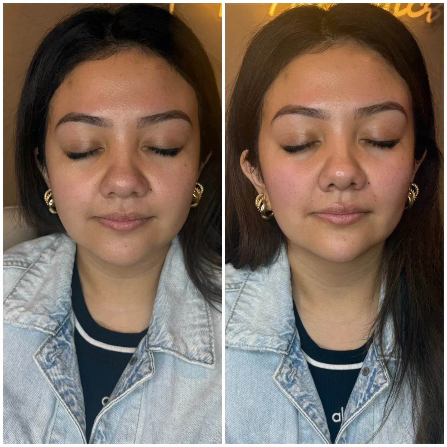 Facial balancing in action ✨

A little in the right places can completely refresh the face while still looking like you.

Treatment details:
&bull; &frac12; syringe each cheek
&bull; &frac12; syringe to the nasolabial &amp; marionette lines
&bull; &f