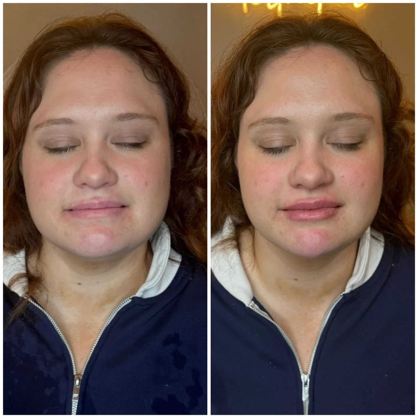 &frac12; syringe to the lips for soft hydration and shape + &frac12; syringe to the chin for balance and structure. Together, they create harmony throughout the lower face without looking overdone.

📍Graceful Beauty Aesthetics &ndash; Ohio Med Spa
1
