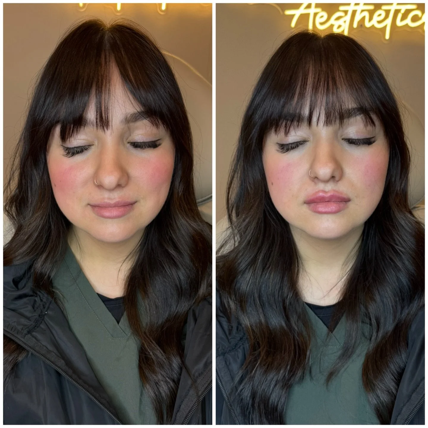 Obsessed with this soft, natural lip filler glow-up 🤍

A little swelling right after is totally normal, but even through it&hellip; look at that Cupid&rsquo;s bow 😍✨ perfectly defined and still so her. 

📲419.520.7127
Graceful Beauty Aesthetics, O