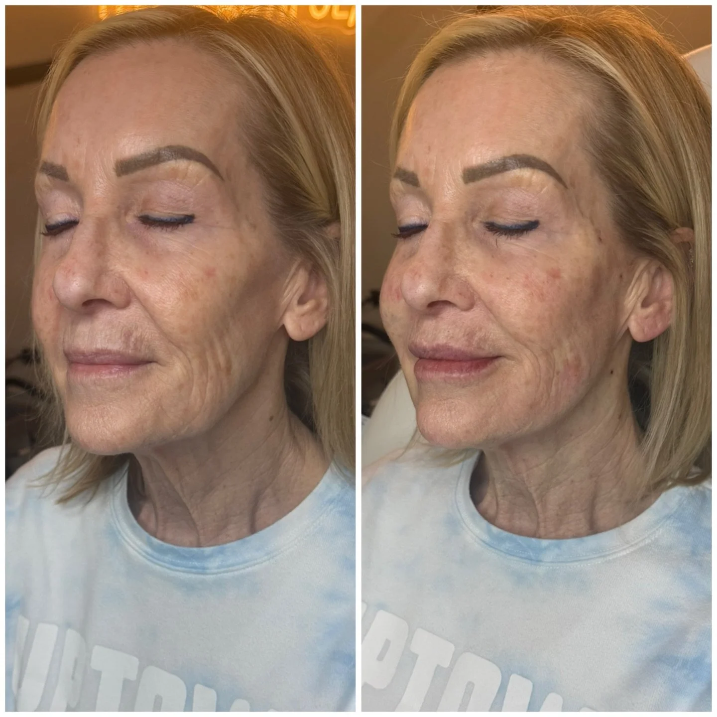 ✨This is your reminder that aging isn&rsquo;t just about lines&hellip; it&rsquo;s about structure, support, and repositioning.

🪡 In her before, you can see heaviness through the lower face, deeper marionette lines, and loss of definition along the 