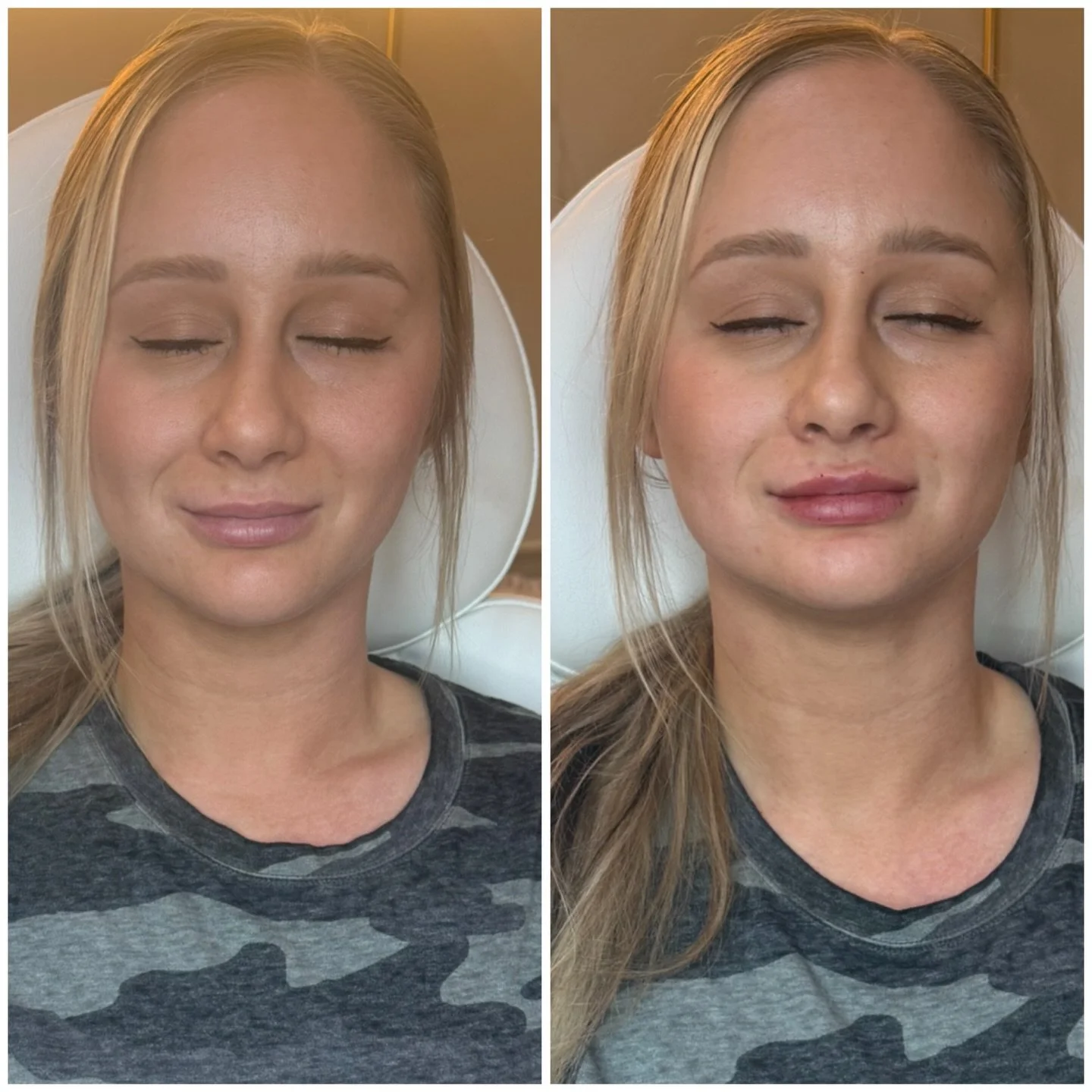 Subtle doesn&rsquo;t mean boring😘

For her, we focused on:
✨ Defining the cupid&rsquo;s bow
✨ Adding subtle volume through the center of the lips
✨ Smoothing + balancing for a more even, hydrated look

Notice how her lips still fit her face perfectl